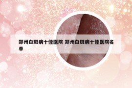 郑州白斑病十佳医院 郑州白斑病十佳医院名单