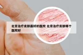北京治疗皮肤最好的医院 北京治疗皮肤哪个医院好