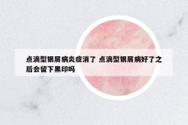 点滴型银屑病炎症消了 点滴型银屑病好了之后会留下黑印吗