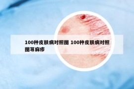 100种皮肤病对照图 100种皮肤病对照图荨麻疹