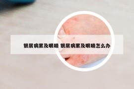 银屑病累及眼睛 银屑病累及眼睛怎么办