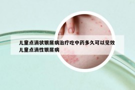 儿童点滴状银屑病治疗吃中药多久可以见效 儿童点滴性银屑病