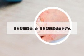 寻常型银屑病uvb 寻常型银屑病能治好么