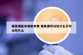 银屑病能食哪些食物 银屑病可以吃什么不可以吃什么