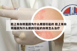 脸上有白斑是因为什么原因引起的 脸上有白斑是因为什么原因引起的白斑怎么治疗