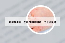 银屑病用药一个月 银屑病用药一个月还是痒