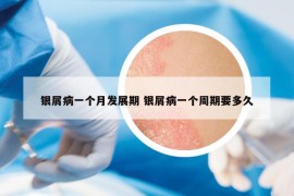 银屑病一个月发展期 银屑病一个周期要多久