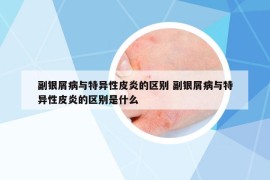 副银屑病与特异性皮炎的区别 副银屑病与特异性皮炎的区别是什么