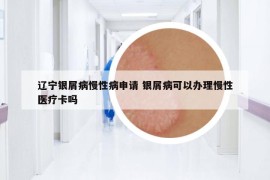 辽宁银屑病慢性病申请 银屑病可以办理慢性医疗卡吗