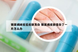 银屑病掉皮后皮肤发白 银屑病皮肤变白了一片怎么办