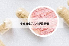 牛皮癣吃了几个虾没事吧