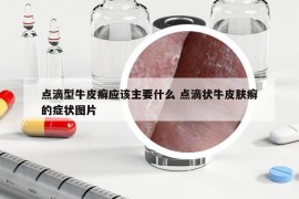 点滴型牛皮癣应该主要什么 点滴状牛皮肤癣的症状图片
