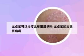 尤卓尔可以治疗儿童银屑病吗 尤卓尔能治银屑病吗