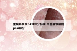 重度银屑病PASI评分标准 中重度银屑病pasi评分