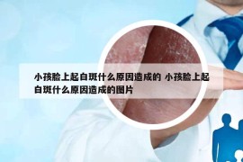 小孩脸上起白斑什么原因造成的 小孩脸上起白斑什么原因造成的图片