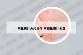 银色用什么药治疗 银褪色用什么洗