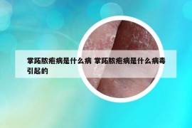 掌跖脓疱病是什么病 掌跖脓疱病是什么病毒引起的