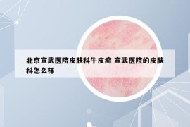 北京宣武医院皮肤科牛皮癣 宣武医院的皮肤科怎么样