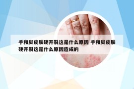 手和脚皮肤硬开裂这是什么原因 手和脚皮肤硬开裂这是什么原因造成的