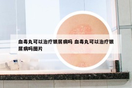 血毒丸可以治疗银屑病吗 血毒丸可以治疗银屑病吗图片
