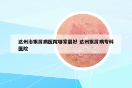 达州治银屑病医院哪家最好 达州银屑病专科医院