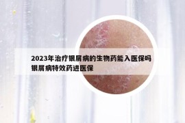 2023年治疗银屑病的生物药能入医保吗 银屑病特效药进医保