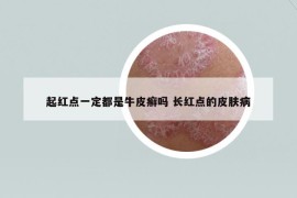 起红点一定都是牛皮癣吗 长红点的皮肤病