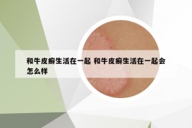 和牛皮癣生活在一起 和牛皮癣生活在一起会怎么样