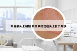 银屑病头上初期 银屑病出现在头上什么症状