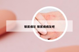 银屑病尔 银屑病病友吧