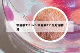 银屑病311uvb 银屑病311光疗副作用