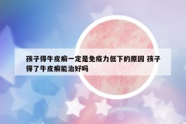 孩子得牛皮癣一定是免疫力低下的原因 孩子得了牛皮癣能治好吗