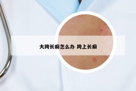 大跨长癣怎么办 跨上长癣