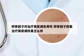 转移因子对治疗银屑病有用吗 转移因子胶囊治疗银屑病效果怎么样