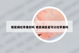 银屑病吃苹果好吗 银屑病患者可以吃苹果吗