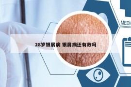 28岁银屑病 银屑病还有救吗
