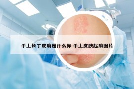 手上长了皮癣是什么样 手上皮肤起癣图片