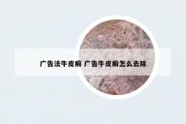 广告法牛皮癣 广告牛皮癣怎么去除