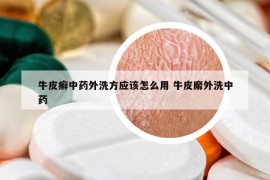 牛皮癣中药外洗方应该怎么用 牛皮廨外洗中药