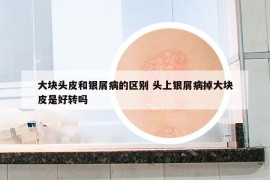 大块头皮和银屑病的区别 头上银屑病掉大块皮是好转吗