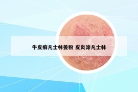 牛皮癣凡士林姜粉 皮炎涂凡士林