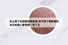 女儿得了比较轻的银屑病 孩子得了银屑病作为父亲我心累得想一死了之