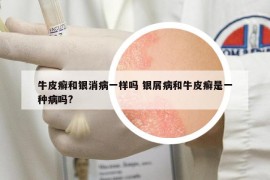 牛皮癣和银消病一样吗 银屑病和牛皮癣是一种病吗?