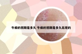 牛癣的初期是多久 牛癣的初期是多久出现的