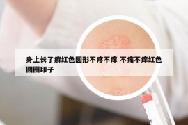 身上长了癣红色圆形不疼不痒 不痛不痒红色圆圈印子