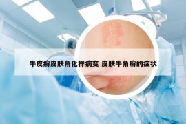 牛皮癣皮肤角化样病变 皮肤牛角癣的症状
