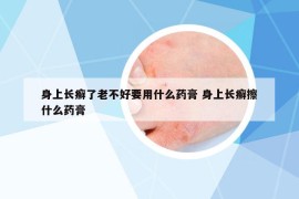 身上长癣了老不好要用什么药膏 身上长癣擦什么药膏