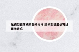 脓疱型银屑病用醋精治疗 脓疱型银屑病可以用激素吗