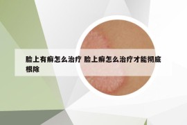 脸上有癣怎么治疗 脸上癣怎么治疗才能彻底根除