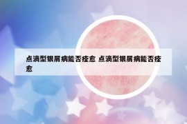 点滴型银屑病能否痊愈 点滴型银屑病能否痊愈